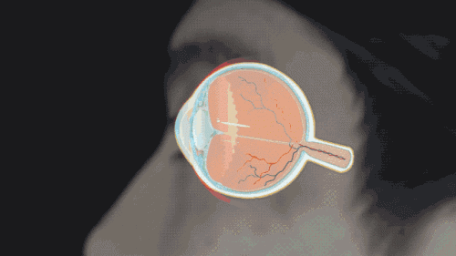 眼底疾病激光手术