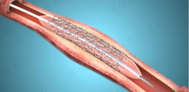 brs由于大多数采用聚乳酸等高分子材料制造,能够在完成支撑作用后逐渐