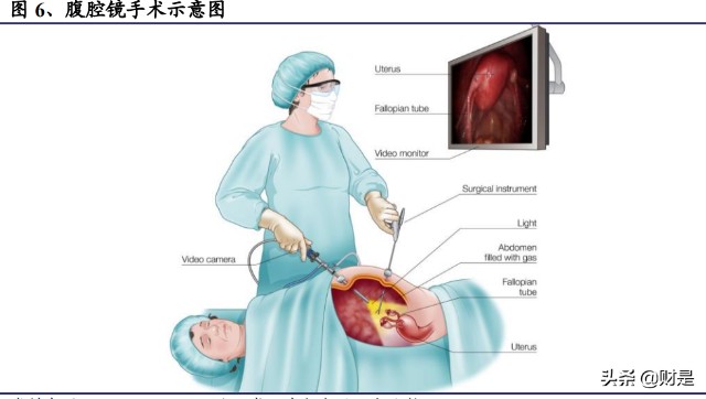 腹腔镜手术是微创外科手术的重要组成部分,在操作过程中,腹腔镜手术多