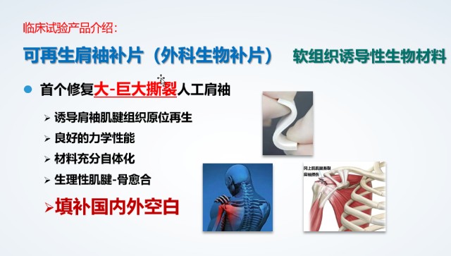 世界首个修复巨大肩袖撕裂的可再生肩袖补片启动注册临床试验 世界首个修复巨大肩袖撕裂的可再生肩袖补片启动注册临床试验