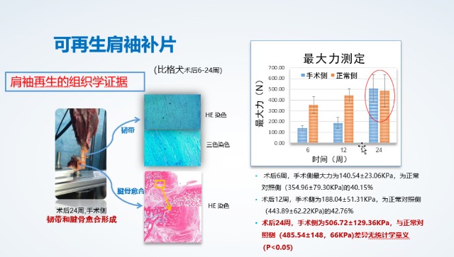 世界首个修复巨大肩袖撕裂的可再生肩袖补片启动注册临床试验 世界首个修复巨大肩袖撕裂的可再生肩袖补片启动注册临床试验
