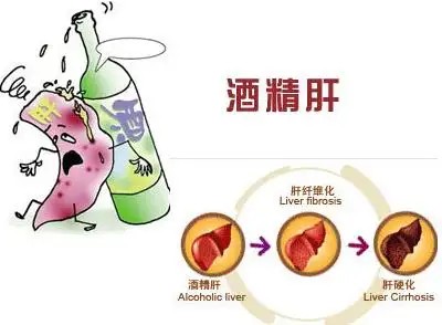 酒精肝患者如果没有及时治疗的话,可能会引起肝腹水,就如同肝硬化或者