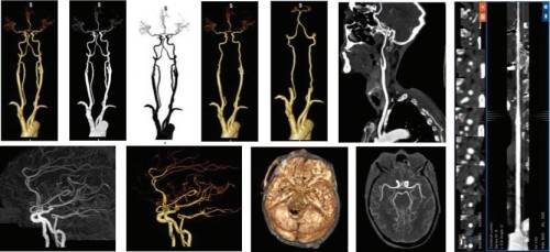 全球首张头颈ctaai三类证获批3min智能完成全流程一站式解决卒中诊疗