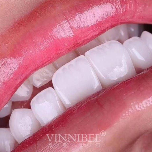 微妮贝尔全瓷贴面圆你亮白美牙梦
