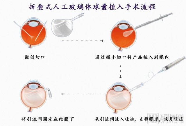卫视博首创折叠式人工玻璃体球囊,解决硅油依赖症等眼疾难题_财富号_