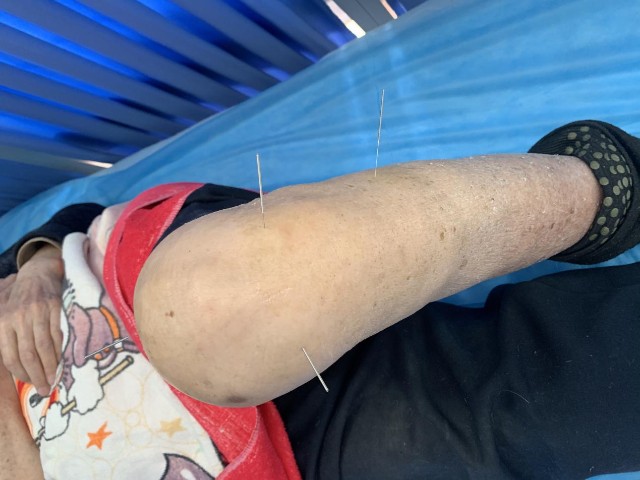 医加壹膝关节炎好中医肖鸿平主任患者康复案例