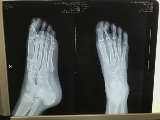 足部dr照片图片
