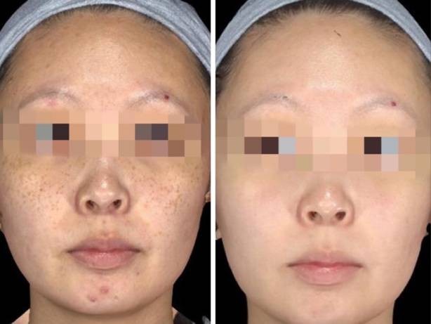 shangli lin提供)【设备对比】除了波长上的区别,755原生皮秒(蜂巢