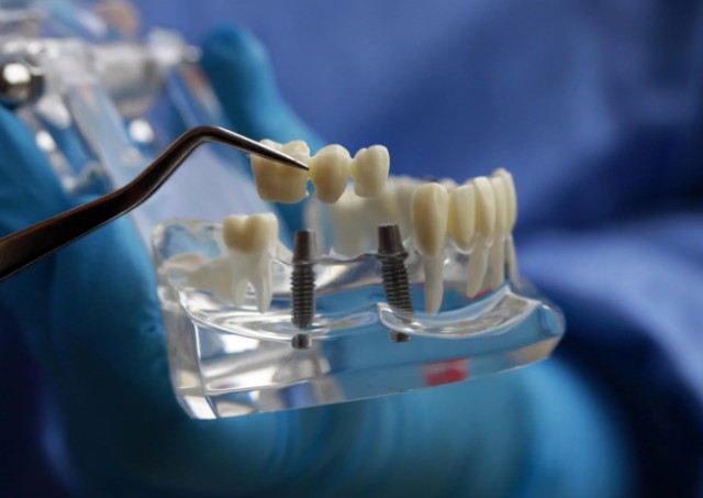 对种植牙应当集采与限价双管齐下