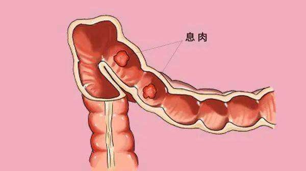 飲食上注意這些有助於預防腸息肉