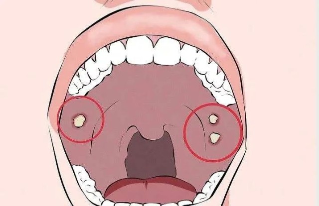 口腔溃疡反复发作究竟是为何?居然是这种病在偷偷作祟!